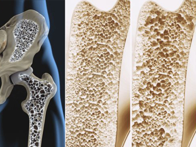 راه های درمان پوکی استخوان
