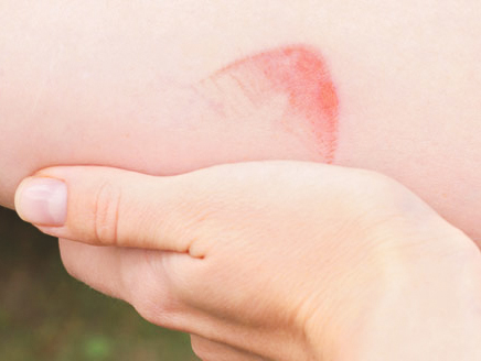 سوختگی با مواد شیمیایی و الکتریسیته