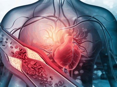 چربی خون عصبی