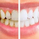 علت ایجاد پلاک دندانی چیست و چگونه آن را کنترل کنیم؟