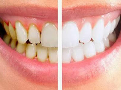 علت ایجاد پلاک دندانی چیست و چگونه آن را کنترل کنیم؟